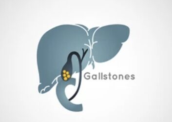 Dissolve Gallstones Easily and Naturally