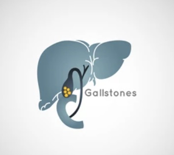 Dissolve Gallstones Easily and Naturally
