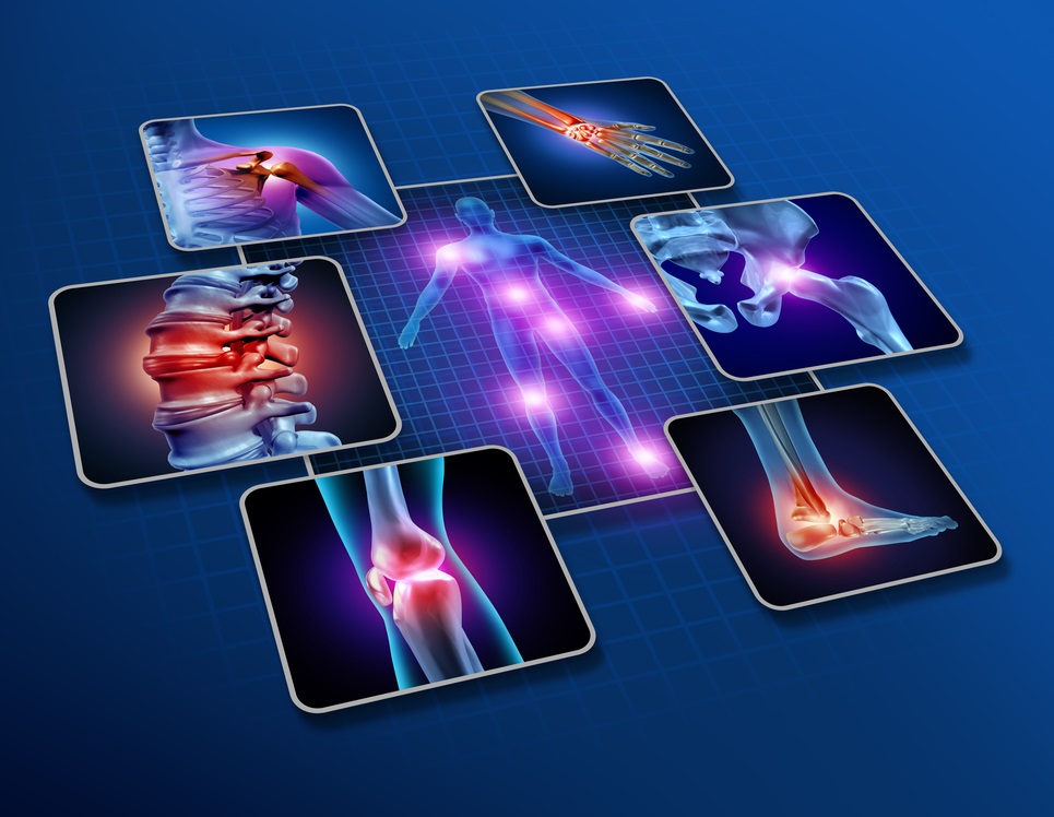 Rheumatoid Arthritis Remission An EvidenceBased Approach with Natural Medicine and Anti